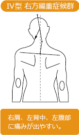 IV型 右方編重症候群 右肩、左背中、左腹部に痛みが出やすい。
